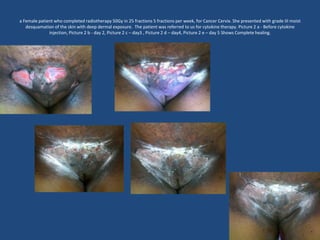 a Female patient who completed radiotherapy 50Gy in 25 fractions 5 fractions per week, for Cancer Cervix. She presented with grade III moist
desquamation of the skin with deep dermal exposure. The patient was referred to us for cytokine therapy. Picture 2 a - Before cytokine
injection, Picture 2 b - day 2, Picture 2 c – day3 , Picture 2 d – day4, Picture 2 e – day 5 Shows Complete healing.
 