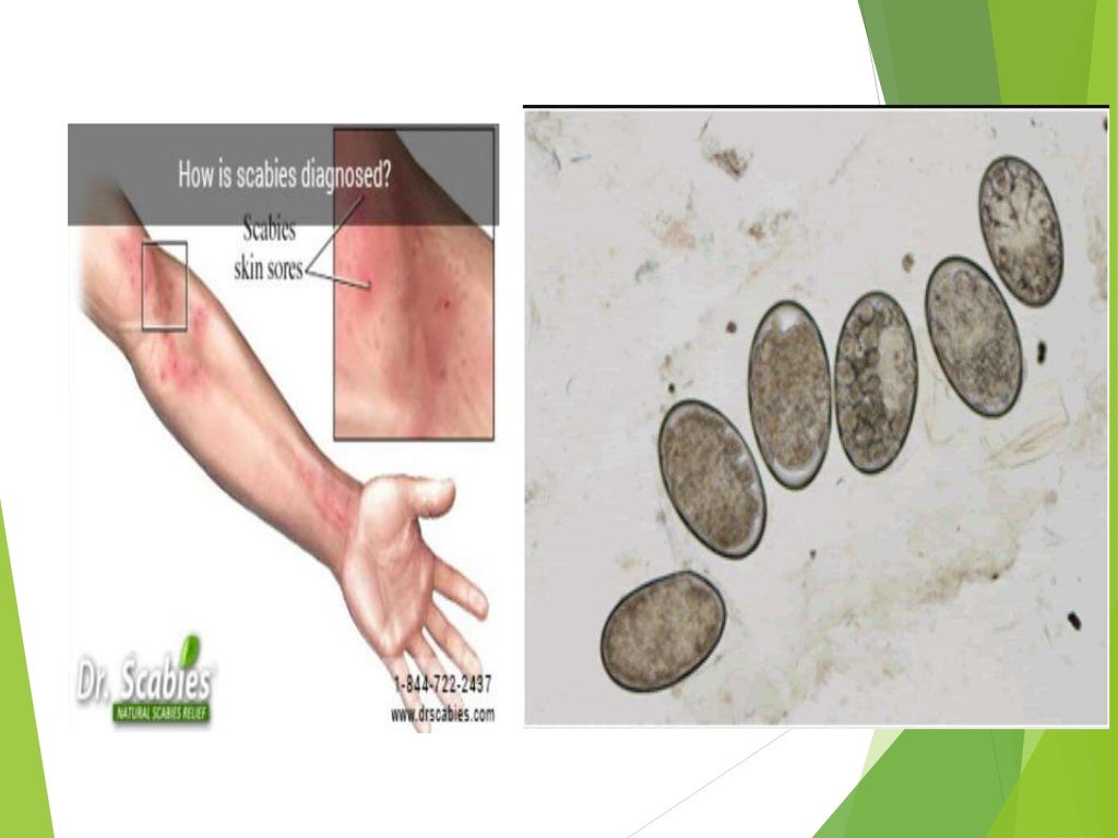 Skin scraping for diagnosis of parasitic diseases