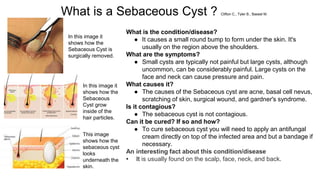 What is a Sebaceous Cyst ? Clifton C., Tyler B., Bassel M.
In this image it
shows how the
Sebaceous
Cyst grow
inside of the
hair particles.
In this image it
shows how the
Sebaceous Cyst is
surgically removed.
This image
shows how the
sebaceous cyst
looks
underneath the
skin.
What is the condition/disease?
● It causes a small round bump to form under the skin. It's
usually on the region above the shoulders.
What are the symptoms?
● Small cysts are typically not painful but large cysts, although
uncommon, can be considerably painful. Large cysts on the
face and neck can cause pressure and pain.
What causes it?
● The causes of the Sebaceous cyst are acne, basal cell nevus,
scratching of skin, surgical wound, and gardner's syndrome.
Is it contagious?
● The sebaceous cyst is not contagious.
Can it be cured? If so and how?
● To cure sebaceous cyst you will need to apply an antifungal
cream directly on top of the infected area and but a bandage if
necessary.
An interesting fact about this condition/disease
• It is usually found on the scalp, face, neck, and back.
 
