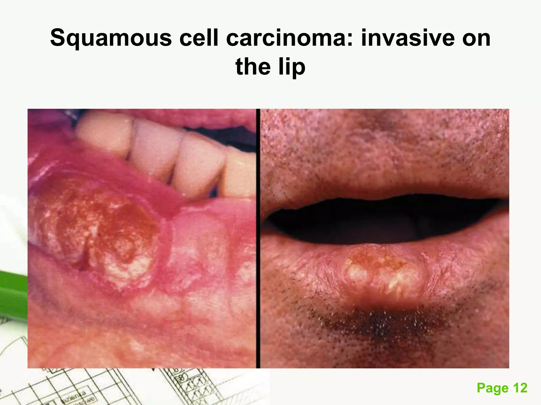 Squamous Cell Carcinoma (SCC)