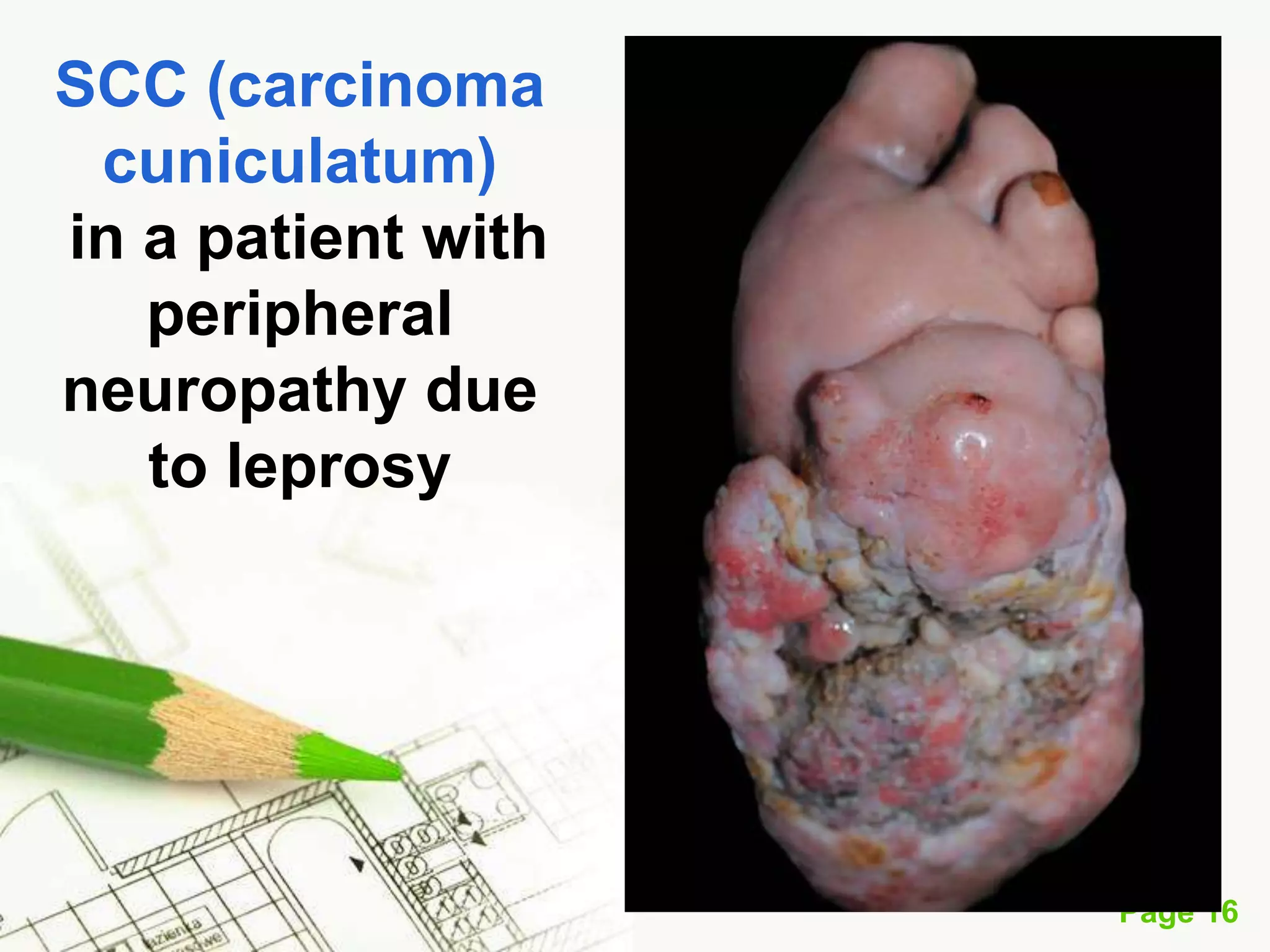 Squamous Cell Carcinoma (SCC)