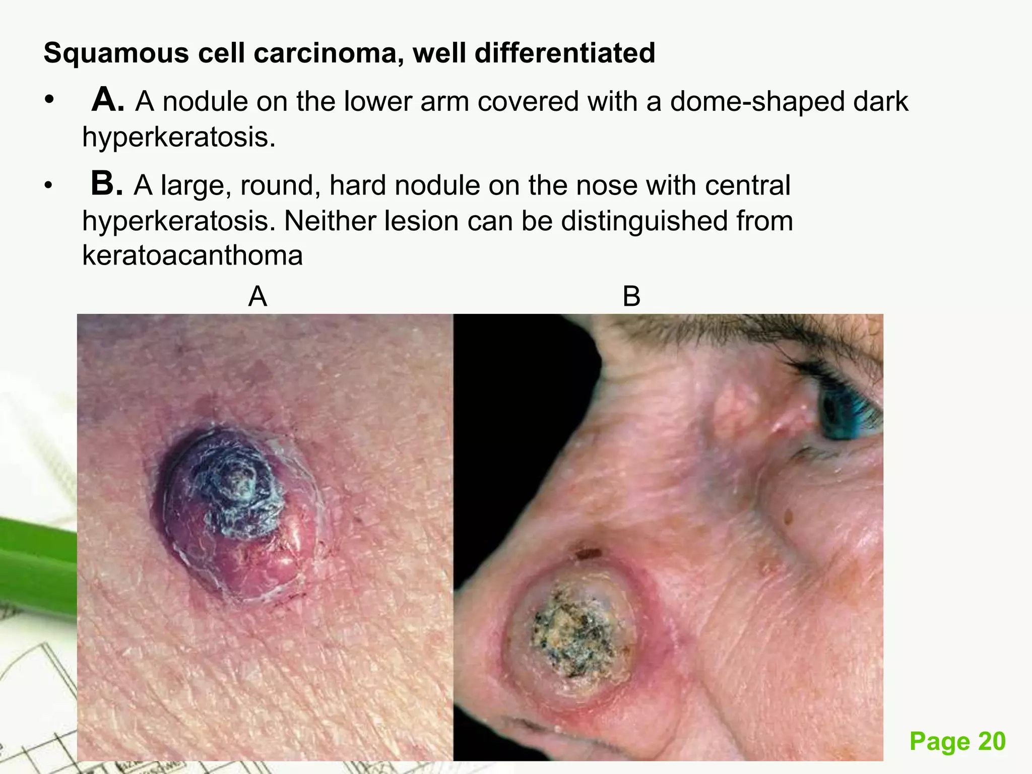 Squamous Cell Carcinoma (SCC)