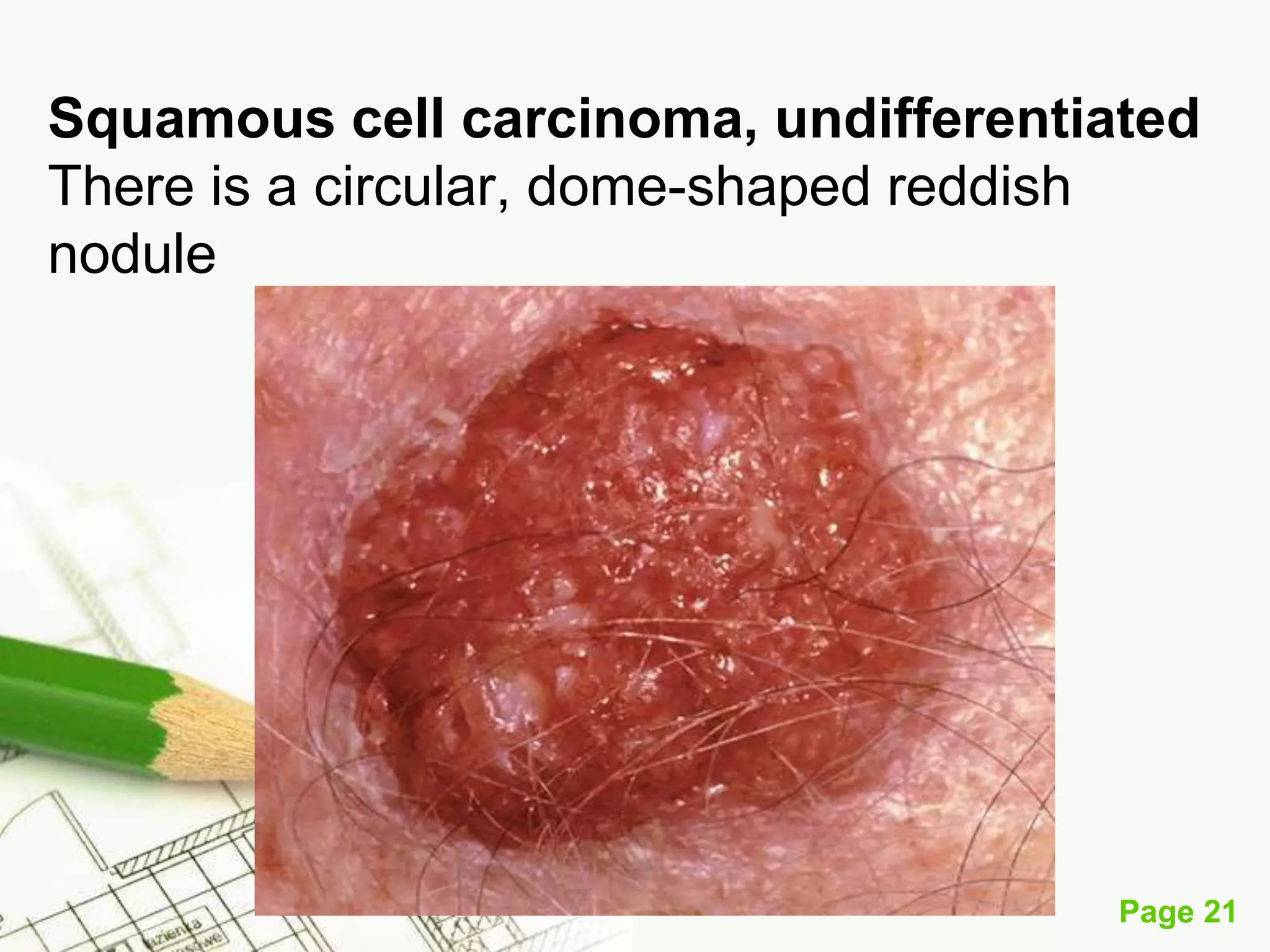 Squamous Cell Carcinoma (SCC)