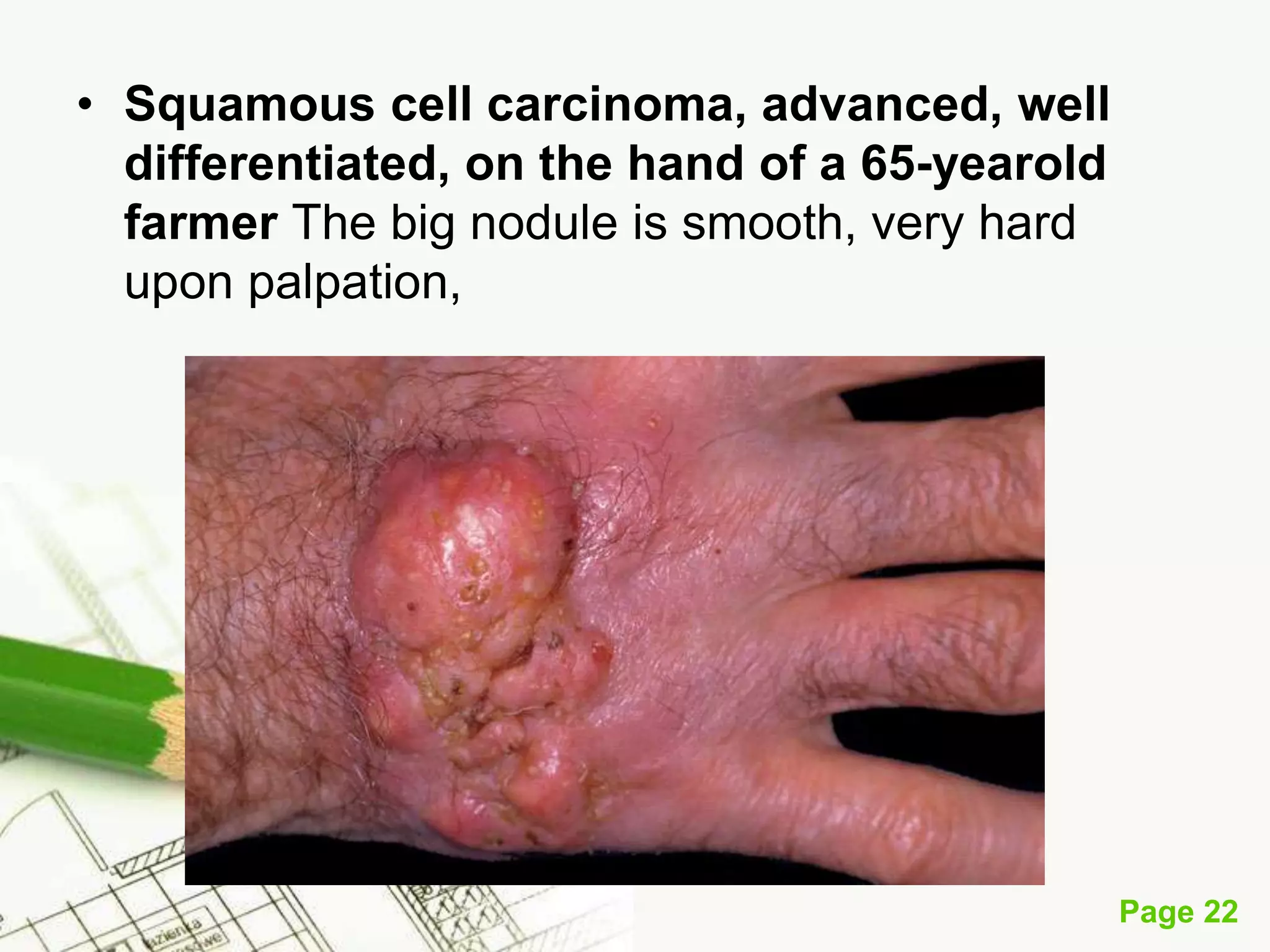 Squamous Cell Carcinoma (SCC)
