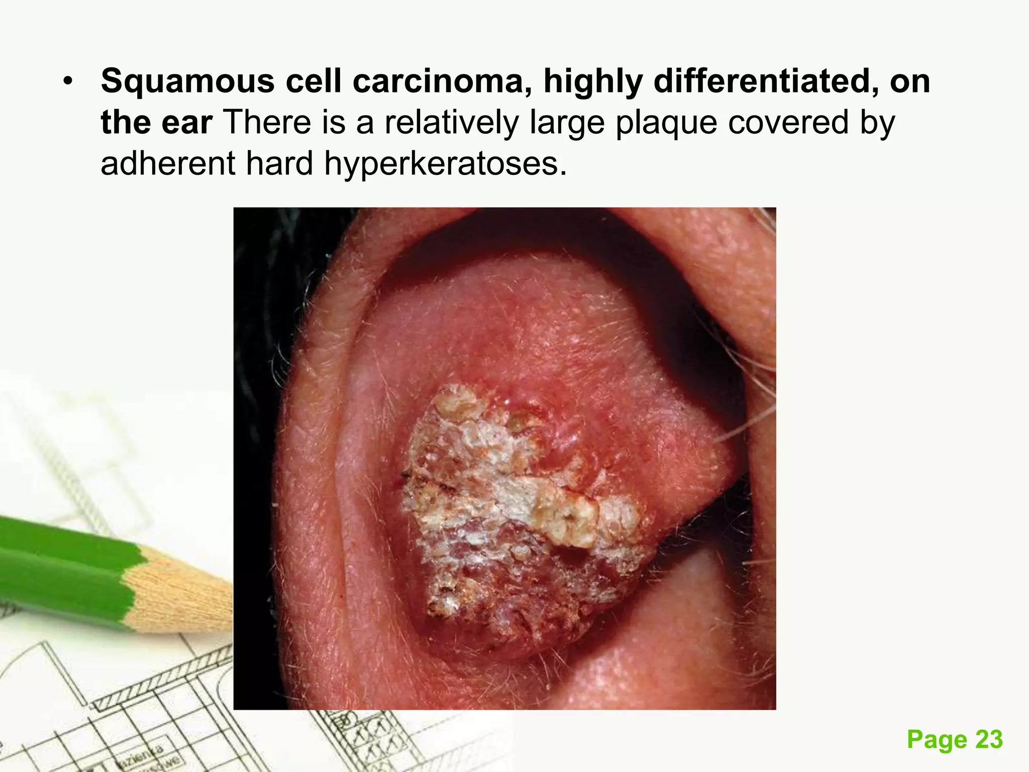 Squamous Cell Carcinoma (SCC)