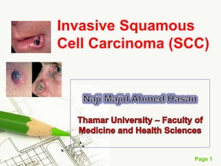 Page 1
Invasive Squamous
Cell Carcinoma (SCC)
 