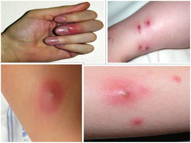 MRSA Pictures: What Does MRSA Look Like on Skin?