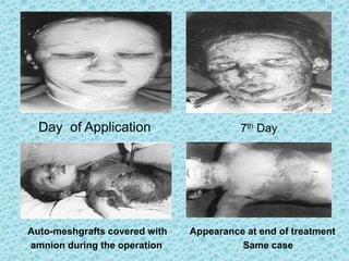 7th DayDay of Application
Auto-meshgrafts covered with
amnion during the operation
Appearance at end of treatment
Same case