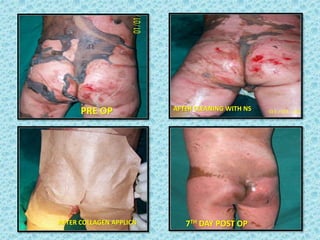 PRE OP
7TH DAY POST OP
AFTER CLEANING WITH NS
AFTER COLLAGEN APPLICN