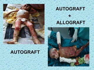 AUTOGRAFT
AUTOGRAFT
+
ALLOGRAFT