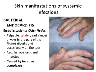 Skin manifestations of systemic
infections
BACTERIAL
ENDOCARDITIS
Embolic Lesions: Osler Nodes
• Palpable, tender, and almost
always in the pulp of the
fingers distally and
occasionally on the toes
• Red, hemorrhagic and
infarcted
• Caused by immune
complexes
 