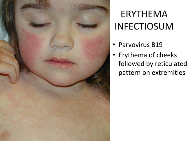 Skin systemic infections final | PPT
