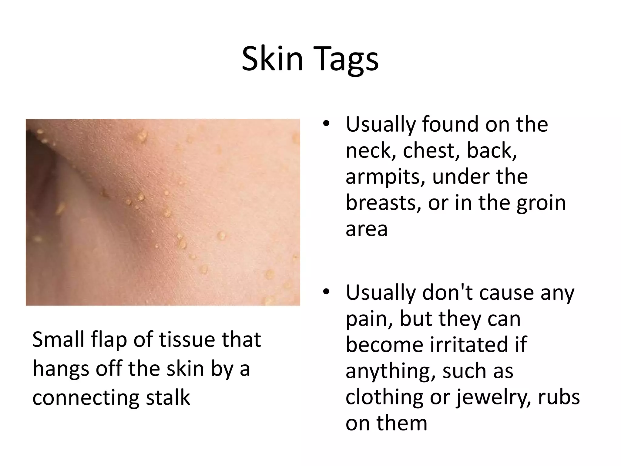 Skin Tag Removal and Skin Biopsies.pptx