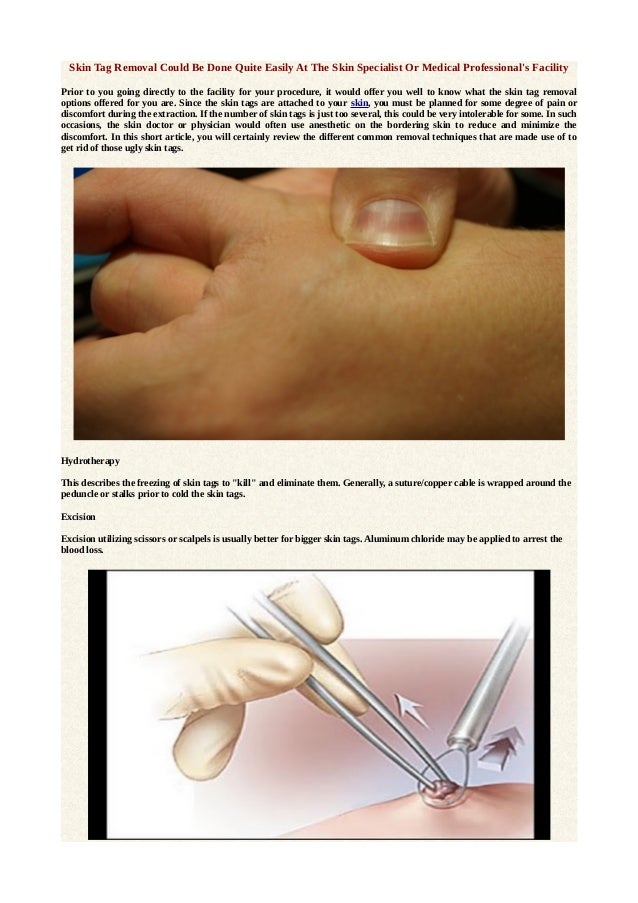 Skin tag removal could be done quite easily at the skin specialist or