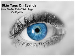 Skin Tags On Eyelids
How To Get Rid of Skin Tags
       On Eyelids
 
