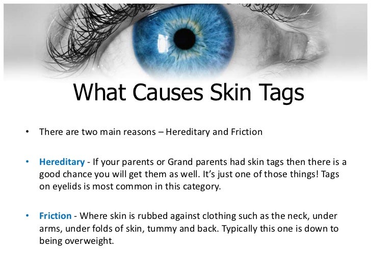 do skin tags on eyelids go away do skin tags on eyelids go away