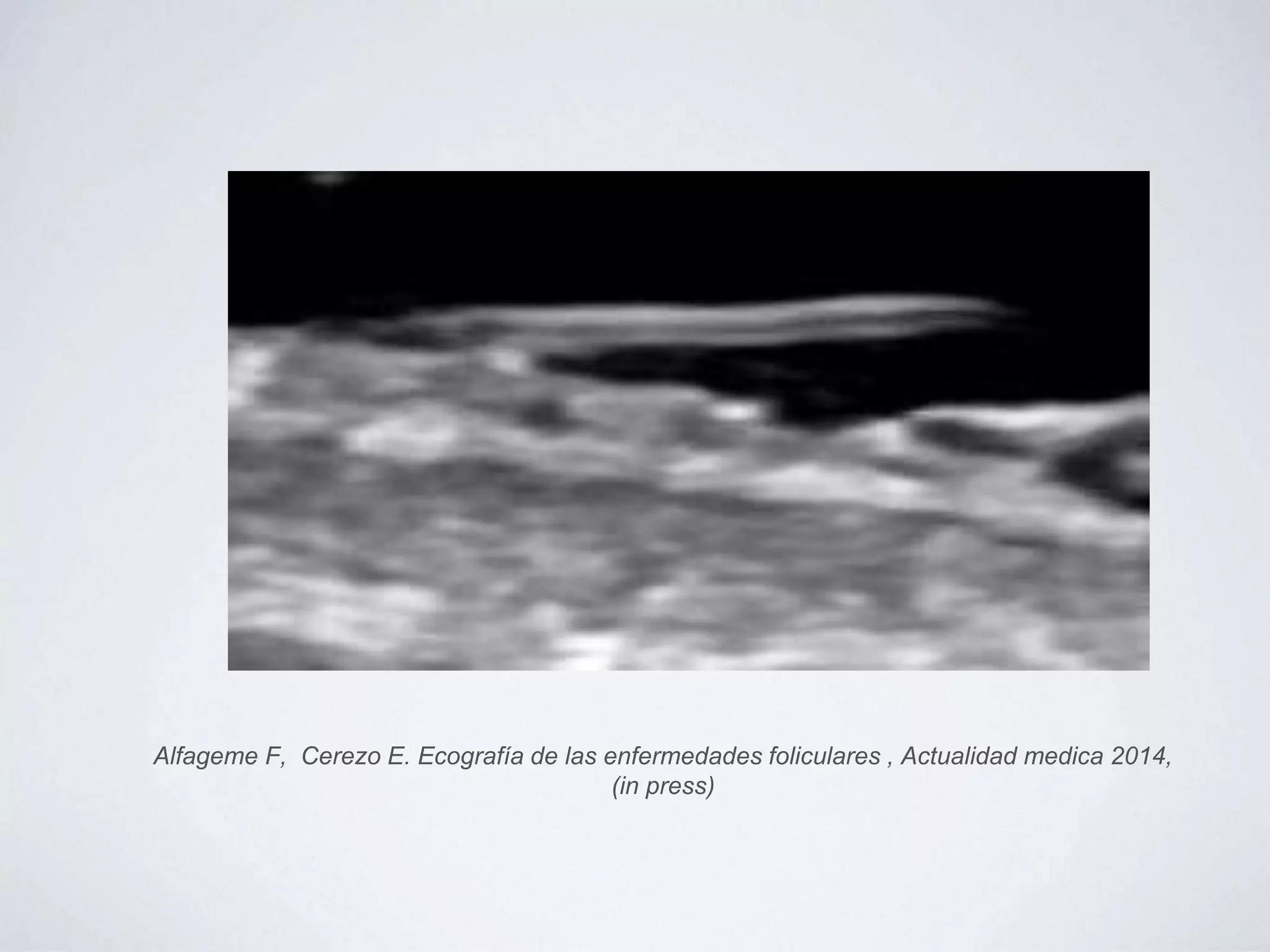 Alfageme F, Cerezo E. Ecografía de las enfermedades foliculares , Actualidad medica 2014,
(in press)
 