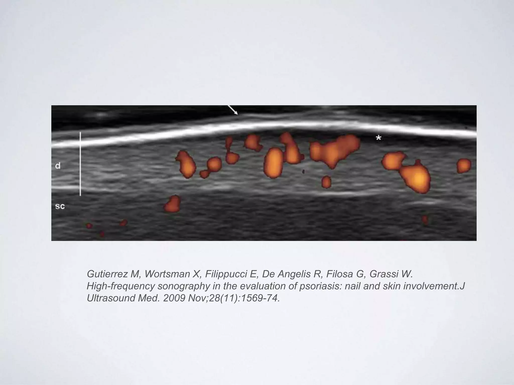 Gutierrez M, Wortsman X, Filippucci E, De Angelis R, Filosa G, Grassi W.
High-frequency sonography in the evaluation of psoriasis: nail and skin involvement.J
Ultrasound Med. 2009 Nov;28(11):1569-74.
 