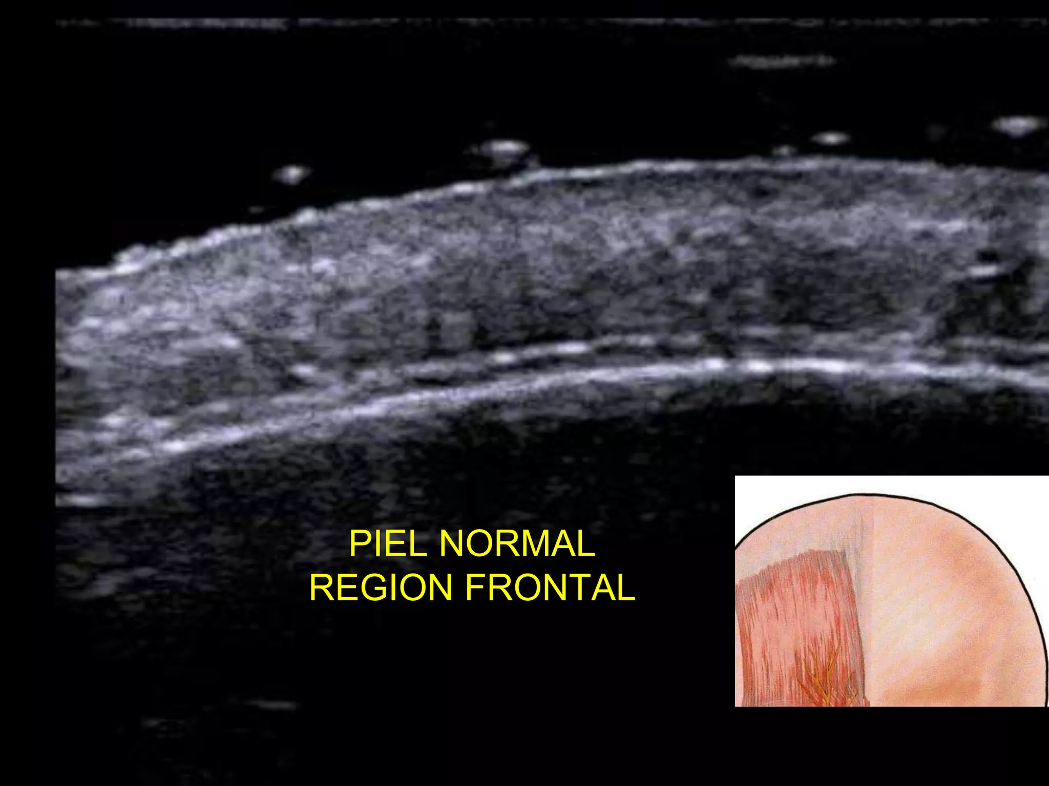 PIEL NORMAL
REGION FRONTAL
 