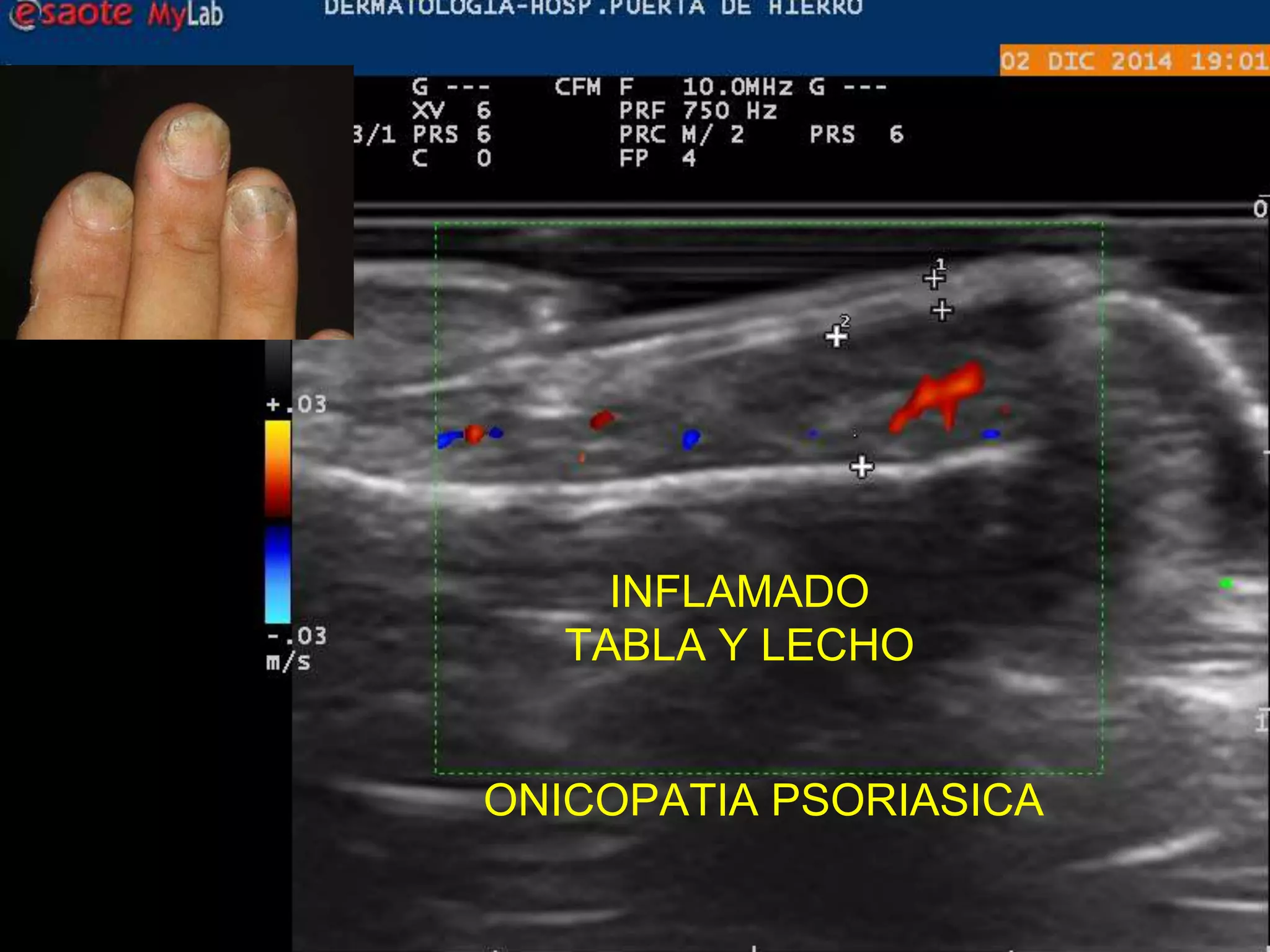 INFLAMADO
TABLA Y LECHO
ONICOPATIA PSORIASICA
 