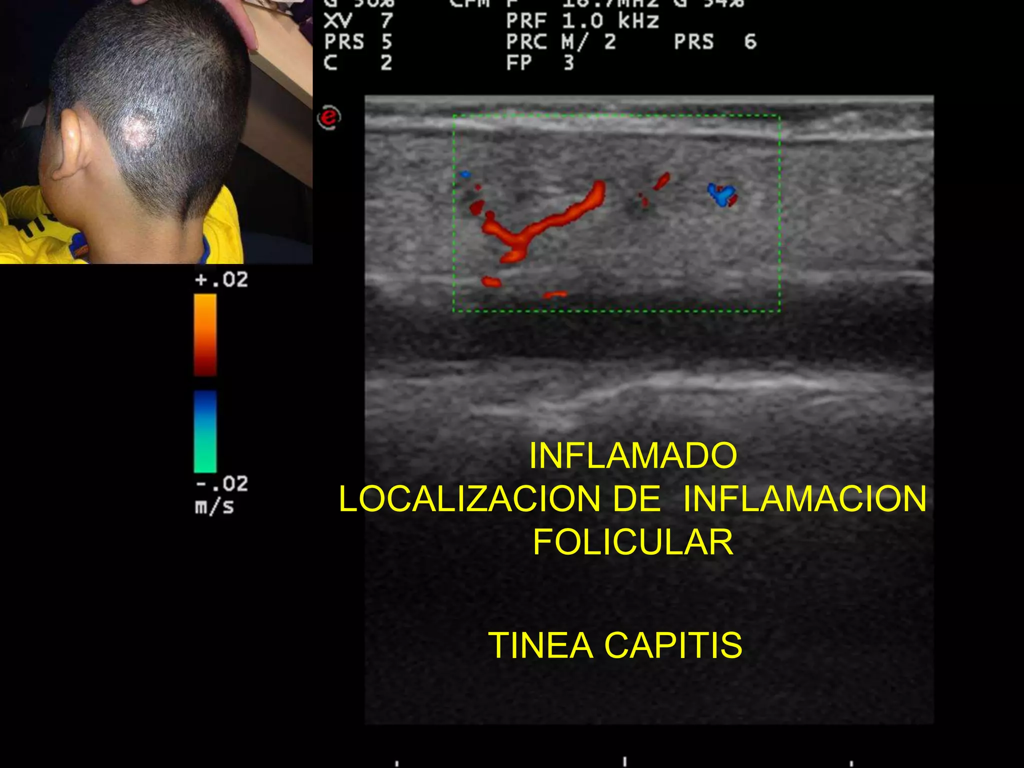 INFLAMADO
LOCALIZACION DE INFLAMACION
FOLICULAR
TINEA CAPITIS
 