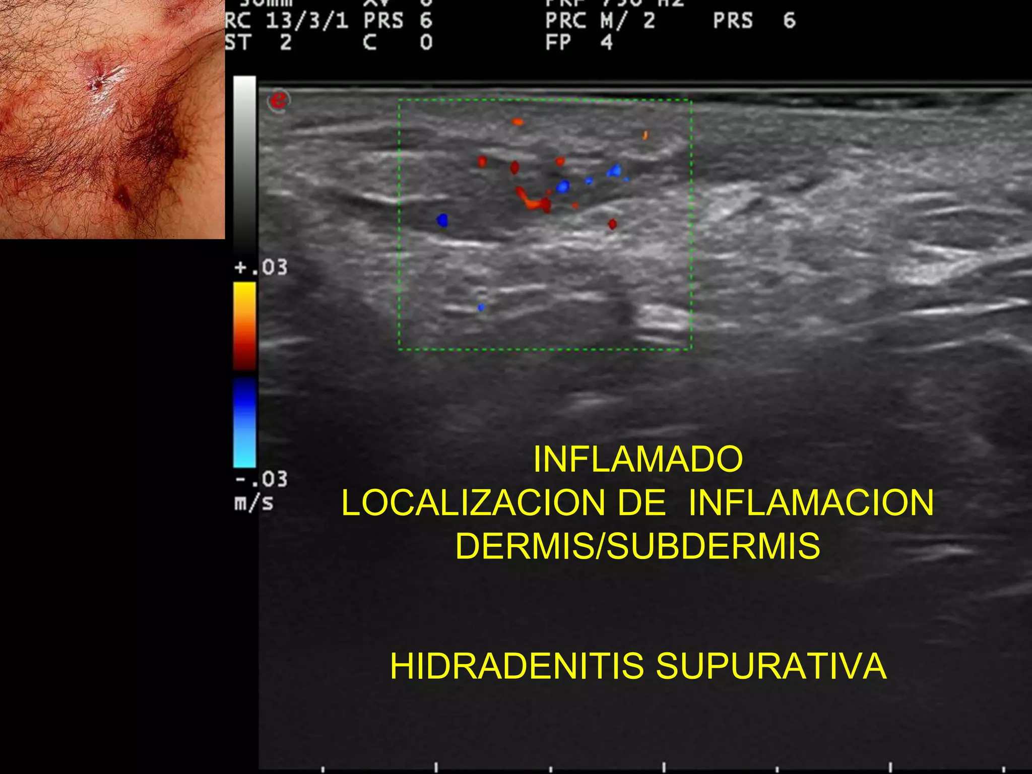 INFLAMADO
LOCALIZACION DE INFLAMACION
DERMIS/SUBDERMIS
HIDRADENITIS SUPURATIVA
 