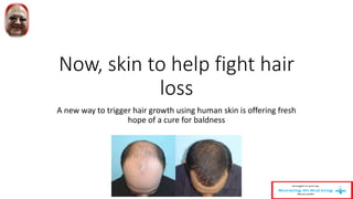 Now, skin to help fight hair
loss
A new way to trigger hair growth using human skin is offering fresh
hope of a cure for baldness
 