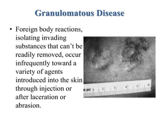 Granulomatous Disease
• Foreign body reactions,
isolating invading
substances that can’t be
readily removed, occur
infrequently toward a
variety of agents
introduced into the skin
through injection or
after laceration or
abrasion.
 