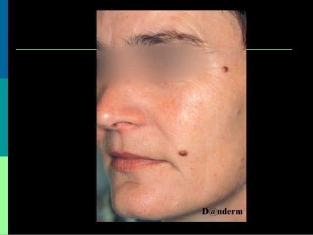 Benign and Malignant Skin Leisions