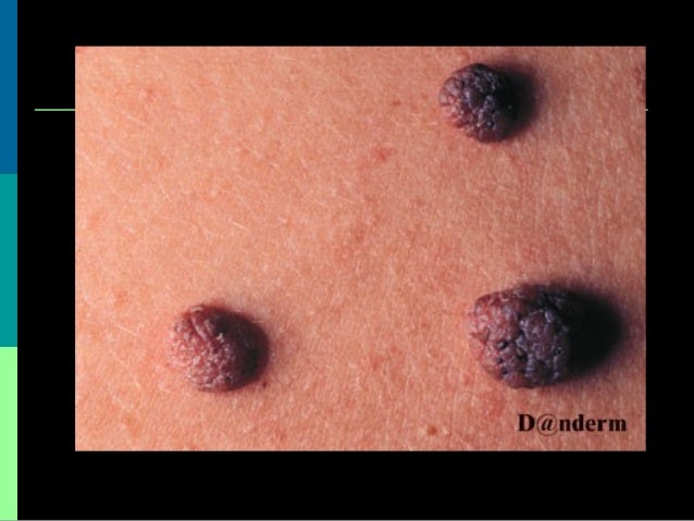 skin tumors benign and malignant skin leisions skin tumors benign and malignant skin leisions