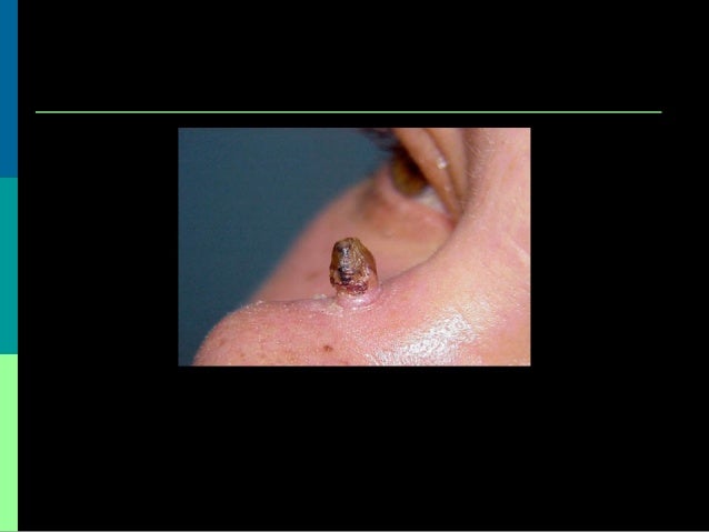 Benign and Malignant Skin Leisions