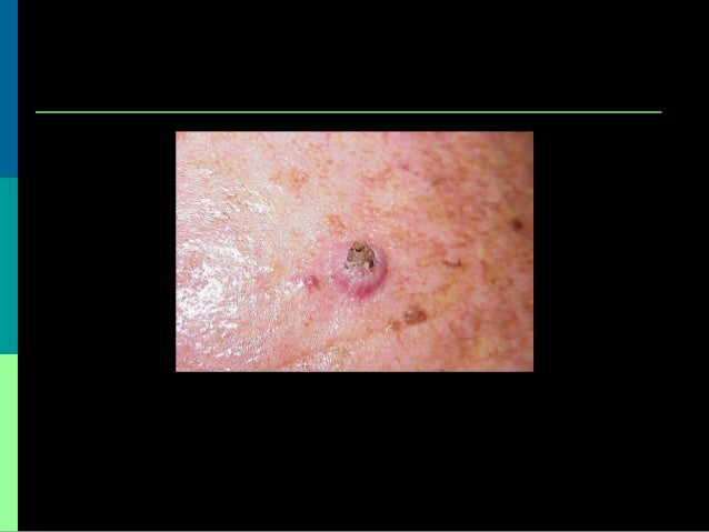 Benign and Malignant Skin Leisions