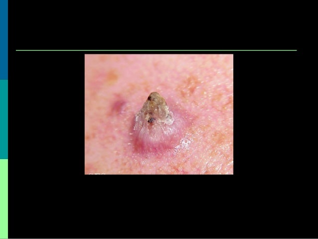 Benign and Malignant Skin Leisions