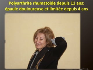 Polyarthrite rhumatoïde depuis 11 ans: épaule douloureuse et limitée depuis 4 ans 