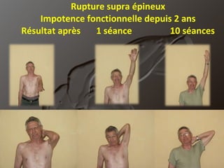 Rupture supra épineux Impotence fonctionnelle depuis 2 ans Résultat après  1 séance  10 séances 