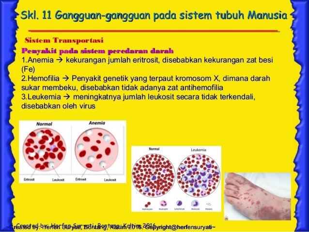 Skl 11 Gangguan Pada Sistem Tubuh Manusia