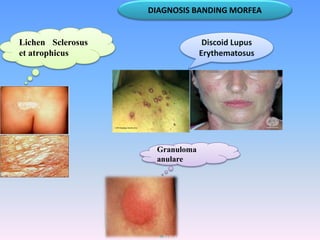 DIAGNOSIS BANDING MORFEA
Lichen Sclerosus
et atrophicus
Discoid Lupus
Erythematosus
Granuloma
anulare
 