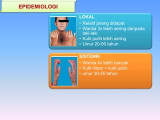 LOKAL
• Relatif jarang didapat
• Wanita 3x lebih sering daripada
laki-laki
• Kulit putih lebih sering
• Umur 20-50 tahun
SISTEMIK
• Wanita 4x lebih banyak
• Kulit hitam > kulit putih.
• umur 30-50 tahun
EPIDEMIOLOGI
 