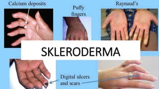 SKLERODERMA
 