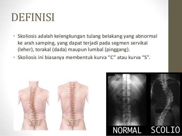 Skoliosis Skoliosis