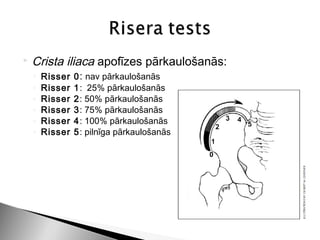    Crista iliaca apofīzes pārkaulošanās:
    ◦   Risser   0 : nav pārkaulošanās
    ◦   Risser   1: 25% pārkaulošanās
    ◦   Risser   2: 50% pārkaulošanās
    ◦   Risser   3: 75% pārkaulošanās
    ◦   Risser   4: 100% pārkaulošanās
    ◦   Risser   5: pilnīga pārkaulošanās
 