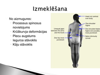 -   No aizmugures:
     • Processus spinosus
       novietojums
     • Krūškurvja deformācijas
     • Plecu augstums
     • Iegurņa stāvoklis
     • Kāju stāvoklis
 