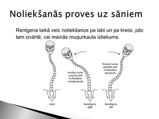    Rentgena laikā veic noliekšanos pa labi un pa kreisi, pēc
    tam izvērtē, vai mainās mugurkaula izliekums.
 