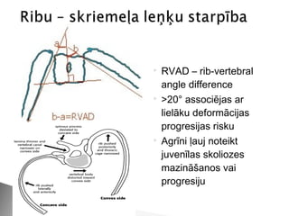    RVAD – rib-vertebral
    angle difference
   >20° associējas ar
    lielāku deformācijas
    progresijas risku
   Agrīni ļauj noteikt
    juvenīlas skoliozes
    mazināšanos vai
    progresiju
 