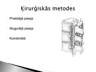    Priekšējā pieeja

   Mugurējā pieeja

   Kombinētā
 