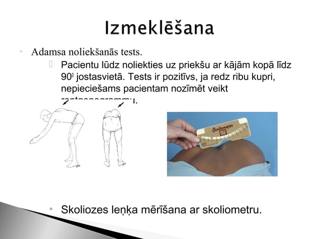 Skolioze