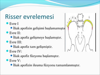 Risser evrelemesi
Evre I
İliak apofizin gelişimi başlamamıştır.
Evre II:
İliak apofiz gelişmeye başlamıştır.
Evre III:
İliak apofiz tam gelişmiştir.
Evre IV:
İliak apofiz füzyonu başlamıştır.
Evre V:
İliak apofizin ileuma füzyonu tamamlanmıştır.
 