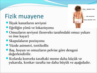 Fizik muayene
İliyak kanatların seviyesi
Eğriliğin yönü ve lokazisyonu
Omuzların seviyesi (konveks tarafındaki omuz yukarı
ve öne kayar)
Skapulaların pozisyonu
Yüzde asimetri, tortikollis
Baş, boyun ve omuzların pelvise göre dengesi
değerlendirilir.
Kızlarda konveks taraftaki meme daha küçük ve
yukarıda, konkav tarafta ise daha büyük ve aşağıdadır.
 