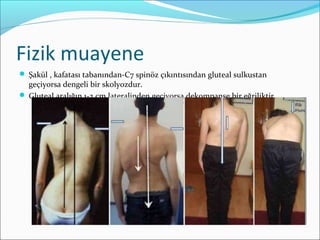 Fizik muayene
 Şakül , kafatası tabanından-C7 spinöz çıkıntısından gluteal sulkustan
geçiyorsa dengeli bir skolyozdur.
 Gluteal aralığın 1-2 cm lateralinden geçiyorsa dekompanse bir eğriliktir.
 