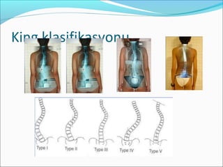 King klasifikasyonu
 